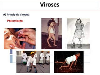 Viroses
9) Principais Viroses

   Poliomielite
 