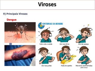 Viroses
9) Principais Viroses

   Dengue
 