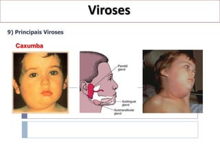 Viroses
9) Principais Viroses

   Caxumba
 