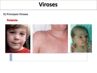 Viroses
9) Principais Viroses

   Rubéola
 