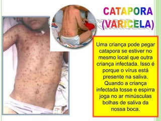 Uma criança pode pegar
catapora se estiver no
mesmo local que outra
criança infectada. Isso é
porque o vírus está
presente na saliva.
Quando a criança
infectada tosse e espirra
joga no ar minúsculas
bolhas de saliva da
nossa boca.
 