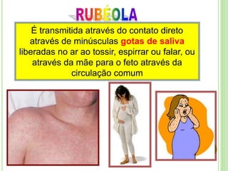 É transmitida através do contato direto
através de minúsculas gotas de saliva
liberadas no ar ao tossir, espirrar ou falar, ou
através da mãe para o feto através da
circulação comum
 