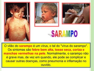 O vilão do sarampo é um vírus, o tal do "vírus do sarampo".
Os sintomas são febre bem alta, tosse seca, coriza e
manchas vermelhas na pele. Normalmente, o sarampo não
é grave mas, de vez em quando, ele pode se complicar e
causar outras doenças, como pneumonia e inflamação no
ouvido.
 