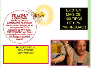 RELAÇÃO SEXUAL
COM PESSOA
CONTAMINADA
EXISTEM
MAIS DE
100 TIPOS
DE HPV
(“VERRUGAS”)
 