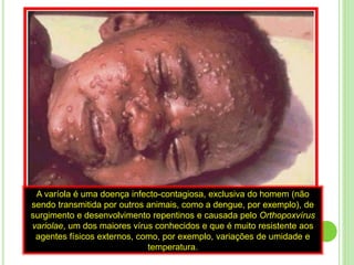 A varíola é uma doença infecto-contagiosa, exclusiva do homem (não
sendo transmitida por outros animais, como a dengue, por exemplo), de
surgimento e desenvolvimento repentinos e causada pelo Orthopoxvírus
variolae, um dos maiores vírus conhecidos e que é muito resistente aos
agentes físicos externos, como, por exemplo, variações de umidade e
temperatura.
 
