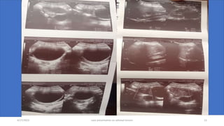 4/17/2023 case presentation on adnexal torsion 12
 