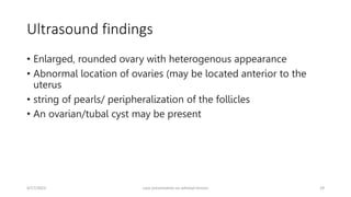 Ultrasound findings
• Enlarged, rounded ovary with heterogenous appearance
• Abnormal location of ovaries (may be located anterior to the
uterus
• string of pearls/ peripheralization of the follicles
• An ovarian/tubal cyst may be present
4/17/2023 case presentation on adnexal torsion 29
 
