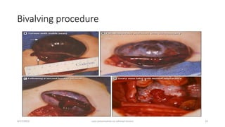 Bivalving procedure
4/17/2023 case presentation on adnexal torsion 33
 