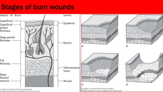 Stages of burn wounds
 