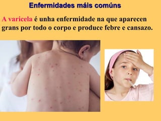 Enfermidades máis comúns
A varicela é unha enfermidade na que aparecen
grans por todo o corpo e produce febre e cansazo.
 