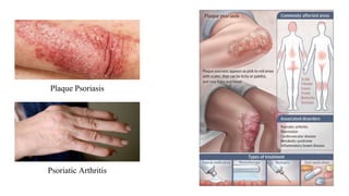 Plaque Psoriasis
Psoriatic Arthritis
 
