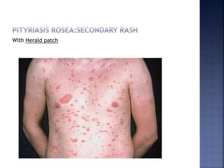 Other cutaneous problems associated with viral infections | PPTX