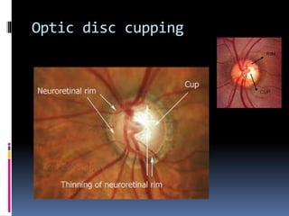 Other eye diseases | PPT