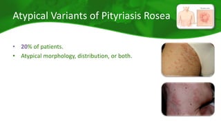 Atypical Variants of Pityriasis Rosea 
• 20% of patients. 
• Atypical morphology, distribution, or both. 
 