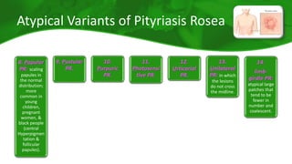 Atypical Variants of Pityriasis Rosea 
8. Papular 
PR: scaling 
papules in 
the normal 
distribution; 
more 
common in 
young 
children, 
pregnant 
women, & 
black people 
(central 
Hyperpigmen 
tation & 
follicular 
papules). 
9. Pustular 
PR. 
10. 
Purpuric 
PR. 
11. 
Photosensi 
tive PR. 
12. 
Urticarial 
PR. 
13. 
Unilateral 
PR: in which 
the lesions 
do not cross 
the midline. 
14. 
limb-girdle 
PR: 
atypical large 
patches that 
tend to be 
fewer in 
number and 
coalescent. 
 