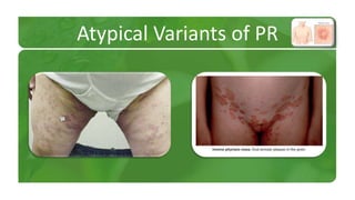 Atypical Variants of PR 
 