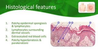 Histological features 
1. Patchy epidermal spongiosis 
& lymphocytes 
2. Lymphocytes surrounding 
dermal vessels 
3. Extravasated red blood cells 
4. Patchy hyperkeratosis & 
parakeratosis 
 