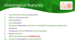 Histological features 
1. Focal (Patchy) or diffuse parakeratosis. 
2. Absence of granular layer. 
3. Mild acanthosis. 
4. Focal spongiosis. 
5. Occasional dyskeratotic cells with an eosinophilic homogeneous appearance. 
6. Exocytosis. 
7. Perivascular dermal infiltration with lymphocytes. 
8. Edema of dermis. 
9. Often some extravasated red blood cells. 
10. Increase in eosinophils in drug induced PR. 
 