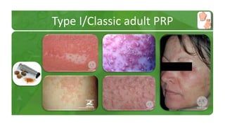 Type I/Classic adult PRP 
 