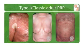 Type I/Classic adult PRP 
 