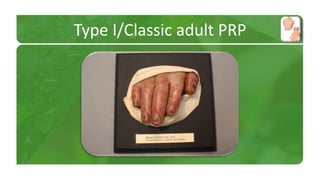 Type I/Classic adult PRP 
 
