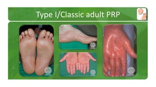 Type I/Classic adult PRP 
 
