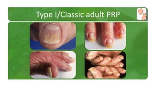 Type I/Classic adult PRP 
 