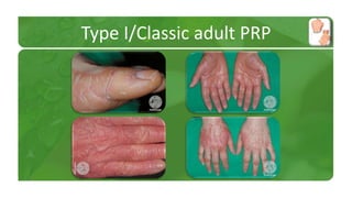 Type I/Classic adult PRP 
 