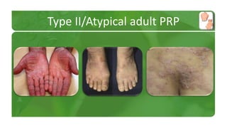 Type II/Atypical adult PRP 
 