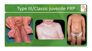 Type III/Classic juvenile PRP 
 