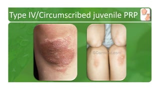 Type IV/Circumscribed juvenile PRP 
 