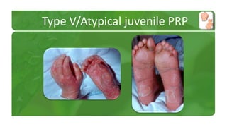 Type V/Atypical juvenile PRP 
 
