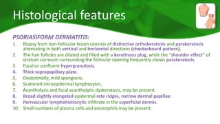 Histological features 
PSORIASIFORM DERMATITIS: 
1. Biopsy from non-follicular lesion consists of distinctive orthokeratosis and parakeratosis 
alternating in both vertical and horizontal directions (checkerboard pattern). 
2. The hair follicles are dilated and filled with a keratinous plug, while the “shoulder effect” of 
stratum corneum surrounding the follicular opening frequently shows parakeratosis. 
3. Focal or confluent hypergranulosis. 
4. Thick suprapapillary plate. 
5. Occasionally, mild spongiosis. 
6. Scattered intraepidermal lymphocytes. 
7. Acantholysis and focal acantholytic dyskeratosis, may be present. 
8. Broad slightly elongated epidermal rete ridges, narrow dermal papillae. 
9. Perivascular lymphohistiocytic infiltrate in the superficial dermis. 
10. Small numbers of plasma cells and eosinophils may be present. 
 