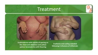 Treatment 
Erythroderma with islands of sparing on 
the chest and abdomen and yellow 
palmar keratoderma with fissuring 
Erythema and scaling subsided 
following 3 infusions of infliximab. 
 