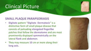 Clinical Picture 
SMALL PLAQUE PARAPSORIASIS 
• Digitate pattern “Digitate Dermatosis” is a 
distinctive form of small plaque disease that 
consists of palisading elongated fingerlike 
patches that follow the dermatome and are most 
prominently displayed symmetrically on the 
lateral flank and abdomen. 
• They may measure 10 cm or more along their 
long axis. 
 