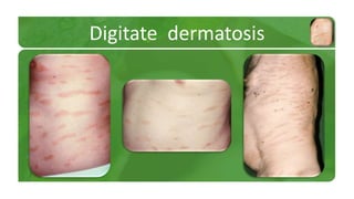 Digitate dermatosis 
 