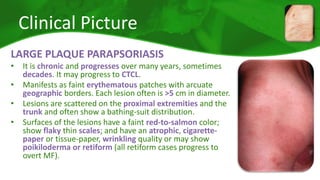 Clinical Picture 
LARGE PLAQUE PARAPSORIASIS 
• It is chronic and progresses over many years, sometimes 
decades. It may progress to CTCL. 
• Manifests as faint erythematous patches with arcuate 
geographic borders. Each lesion often is >5 cm in diameter. 
• Lesions are scattered on the proximal extremities and the 
trunk and often show a bathing-suit distribution. 
• Surfaces of the lesions have a faint red-to-salmon color; 
show flaky thin scales; and have an atrophic, cigarette-paper 
or tissue-paper, wrinkling quality or may show 
poikiloderma or retiform (all retiform cases progress to 
overt MF). 
 