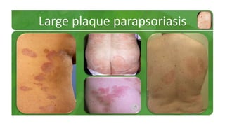 Large plaque parapsoriasis 
 