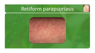 Retiform parapsoriasis 
 