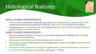 Histological features 
SMALL PLAQUE PARAPSORIASIS 
• Exhibit a mild, nonspecific spongiotic dermatitis, focal hyperkeratosis, parakeratosis mild 
superficial perivascular lymphocytic infiltrate, scale crust, and occasional exocytosis. 
• Lymphocytes are small and do not show atypical features. do not show histologic atypia to 
suggest malignant transformation. 
LARGE PLAQUE PARAPSORIASIS 
• May have similar histologic findings or an interface lymphocytic infiltrate with a variable 
degree of lichenoid features. 
• Blood vessels are dilated, and melanophages can be present. 
• The epidermis shows flattening of the rete ridges when epidermal atrophy is prominent on 
clinical examination. 
• Acanthosis of the epidermis and irregular hyperkeratosis of the cornified layer are present. 
• In contrast to small plaque parapsoriasis, spongiosis is absent. 
 