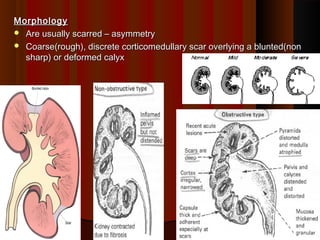 MorphologyMorphology
 Are usually scarred – asymmetryAre usually scarred – asymmetry
 Coarse(rough), discrete corticomedullary scar overlying a blunted(nonCoarse(rough), discrete corticomedullary scar overlying a blunted(non
sharp) or deformed calyxsharp) or deformed calyx
1010
 