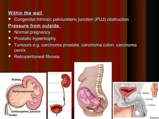 Within the wallWithin the wall
 Congenital Intrinsic pelviureteric junction (PUJ) obstructionCongenital Intrinsic pelviureteric junction (PUJ) obstruction
Pressure from outsidePressure from outside
 Normal pregnancyNormal pregnancy
 Prostatic hypertrophyProstatic hypertrophy
 Tumours e.g. carcinoma prostate, carcinoma colon, carcinomaTumours e.g. carcinoma prostate, carcinoma colon, carcinoma
cervixcervix
 Retroperitoneal fibrosisRetroperitoneal fibrosis
1212
 