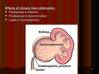 Effects of Urinary tract obstructionEffects of Urinary tract obstruction
 Predisposes to infectionPredisposes to infection
 Predisposes to stone formationPredisposes to stone formation
 Leads to hydronephrosisLeads to hydronephrosis
1414
 