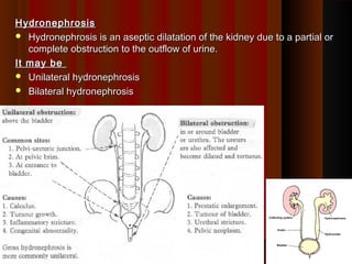 HydronephrosisHydronephrosis
 Hydronephrosis is an aseptic dilatation of the kidney due to a partial orHydronephrosis is an aseptic dilatation of the kidney due to a partial or
complete obstruction to the outflow of urine.complete obstruction to the outflow of urine.
It may beIt may be
 Unilateral hydronephrosisUnilateral hydronephrosis
 Bilateral hydronephrosisBilateral hydronephrosis
1515
 