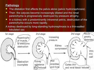 PathologyPathology
 The dilatation first affects the pelvis alone (pelvic hydronephrosis).The dilatation first affects the pelvis alone (pelvic hydronephrosis).
 Then the calyces become increasingly dilated and the renalThen the calyces become increasingly dilated and the renal
parenchyma is progressively destroyed by pressure atrophy.parenchyma is progressively destroyed by pressure atrophy.
 In a kidney with a predominantly intrarenal pelvis, destruction of theIn a kidney with a predominantly intrarenal pelvis, destruction of the
parenchyma occurs more rapidly.parenchyma occurs more rapidly.
A kidney destroyed by long-standing hydronephrosis is a thin-walledA kidney destroyed by long-standing hydronephrosis is a thin-walled
lobulated saclobulated sac
1616
 