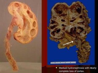  Marked hydronephrosis with nearlyMarked hydronephrosis with nearly
complete loss of cortex.complete loss of cortex.
1717
 