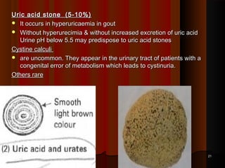 Uric acid stone (5-10%)Uric acid stone (5-10%)
 It occurs in hyperuricaemia in goutIt occurs in hyperuricaemia in gout
 Without hyperurecimia & without increased excretion of uric acidWithout hyperurecimia & without increased excretion of uric acid
Urine pH below 5.5 may predispose to uric acid stonesUrine pH below 5.5 may predispose to uric acid stones
Cystine calculiCystine calculi
 are uncommon. They appear in the urinary tract of patients with aare uncommon. They appear in the urinary tract of patients with a
congenital error of metabolism which leads to cystinuria.congenital error of metabolism which leads to cystinuria.
Others rareOthers rare
2121
 