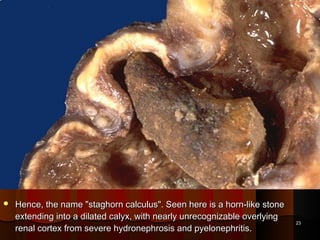  Hence, the name "staghorn calculus". Seen here is a horn-like stoneHence, the name "staghorn calculus". Seen here is a horn-like stone
extending into a dilated calyx, with nearly unrecognizable overlyingextending into a dilated calyx, with nearly unrecognizable overlying
renal cortex from severe hydronephrosis and pyelonephritis.renal cortex from severe hydronephrosis and pyelonephritis.
2323
 
