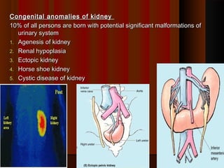 Congenital anomalies of kidneyCongenital anomalies of kidney
10% of all persons are born with potential significant malformations of10% of all persons are born with potential significant malformations of
urinary systemurinary system
1.1. Agenesis of kidneyAgenesis of kidney
2.2. Renal hypoplasiaRenal hypoplasia
3.3. Ectopic kidneyEctopic kidney
4.4. Horse shoe kidneyHorse shoe kidney
5.5. Cystic disease of kidneyCystic disease of kidney
2424
 