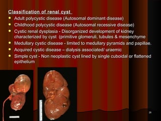 Classification of renal cystClassification of renal cyst
 Adult polycystic disease (Autosomal dominant disease)Adult polycystic disease (Autosomal dominant disease)
 Childhood polycystic disease (Autosomal recessive disease)Childhood polycystic disease (Autosomal recessive disease)
 Cystic renal dysplasia - Disorganized development of kidneyCystic renal dysplasia - Disorganized development of kidney
characterized by cyst (primitive glomeruli, tubules & mesenchymecharacterized by cyst (primitive glomeruli, tubules & mesenchyme
 Medullary cystic disease - limited to medullary pyramids and papillae.Medullary cystic disease - limited to medullary pyramids and papillae.
 Acquired cystic disease – dialysis associated/ uraemicAcquired cystic disease – dialysis associated/ uraemic
 Simple cyst - Non neoplastic cyst lined by single cuboidal or flattenedSimple cyst - Non neoplastic cyst lined by single cuboidal or flattened
epitheliumepithelium
2626
 